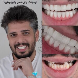 ایمپلنت با بیحسی یا بیهوشی ؟