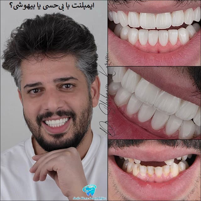 ایمپلنت با بی‌حسی یا بیهوشی ؟