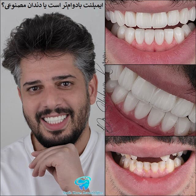 ایمپلنت بادوام‌تره یا دندان مصنوعی