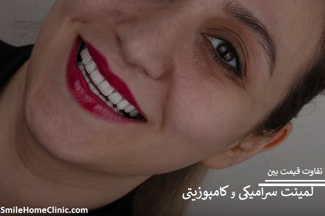 تفاوت قیمت بین لمینت سرامیکی و کامپوزیتی