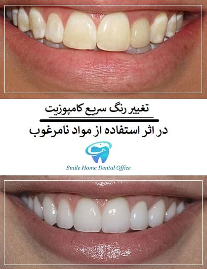  تغییر رنگ سریع کامپوزیت در اثر استفاده از مواد نامرغوب