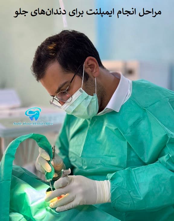 مراحل انجام ایمپلنت برای دندان‌های جلو