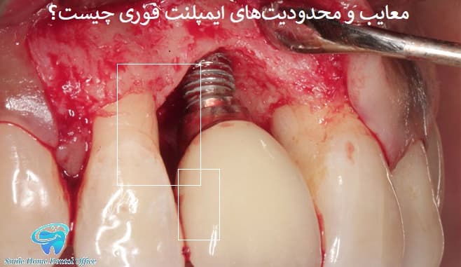 معایب و محدودیت‌های ایمپلنت فوری چیست؟