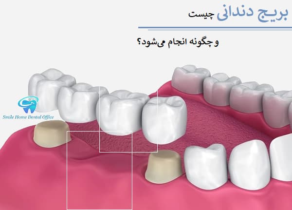 بریج دندانی چیست و چگونه انجام می‌شود؟