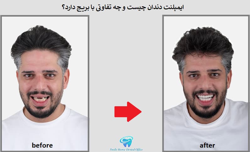 ایمپلنت دندان چیست و چه تفاوتی با بریج دارد؟