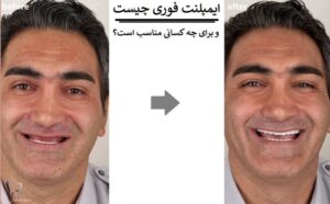 ایمپلنت فوری چیست و برای چه کسانی مناسب است؟