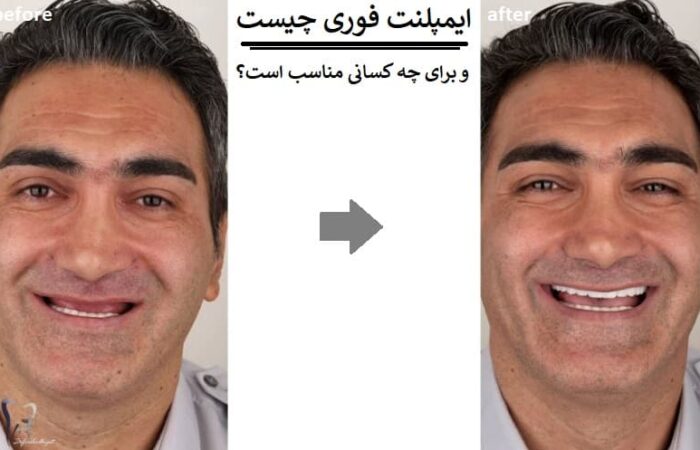 ایمپلنت فوری چیست و برای چه کسانی مناسب است؟