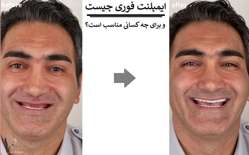 ایمپلنت فوری چیست و برای چه کسانی مناسب است؟