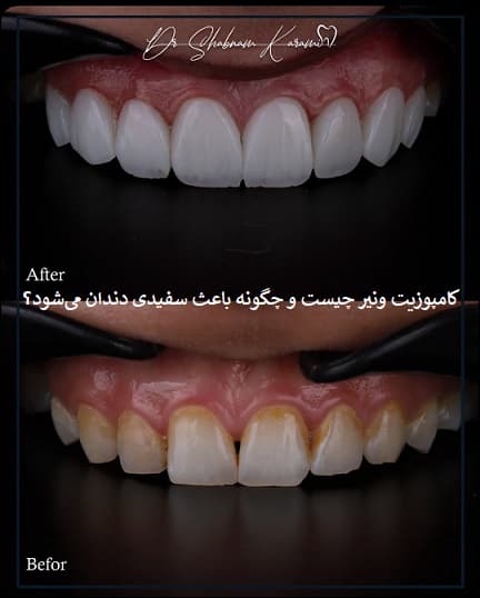 کامپوزیت ونیر چیست و چگونه باعث سفیدی دندان می‌شود؟