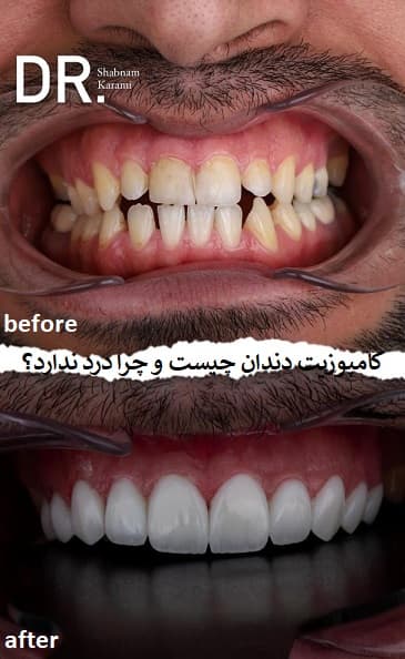 کامپوزیت دندان چیست و چرا درد ندارد؟