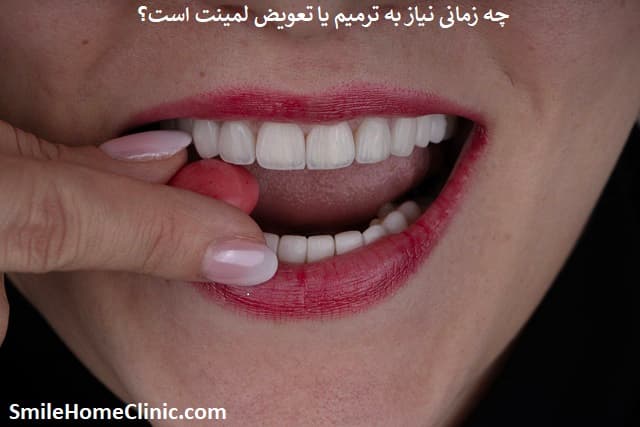 چه زمانی نیاز به ترمیم یا تعویض لمینت است؟