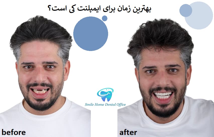 بهترین زمان برای ایمپلنت کی است؟