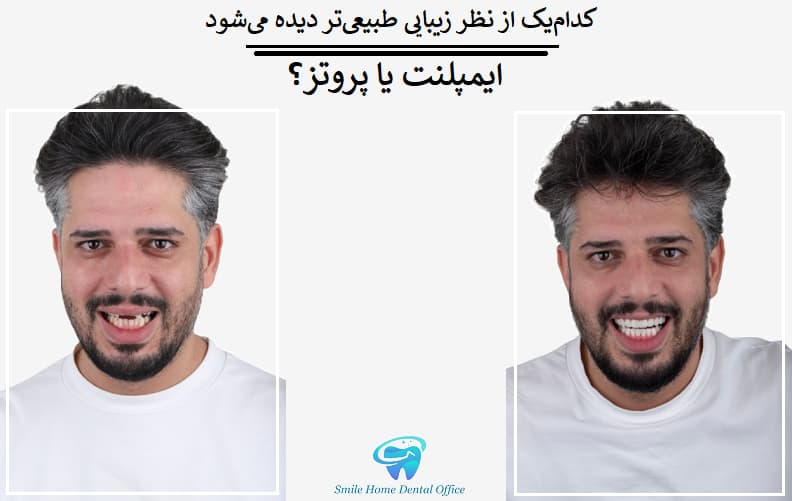 کدام‌یک از نظر زیبایی طبیعی‌تر دیده می‌شود؛ ایمپلنت یا پروتز؟