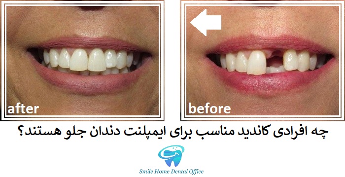 چه افرادی کاندید مناسب برای ایمپلنت دندان جلو هستند؟