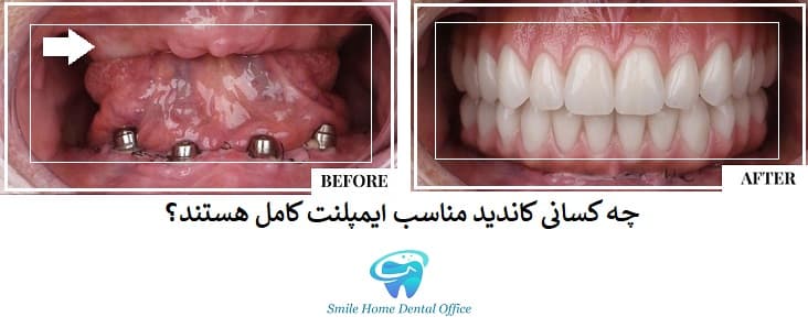 چه کسانی کاندید مناسب ایمپلنت کامل هستند؟