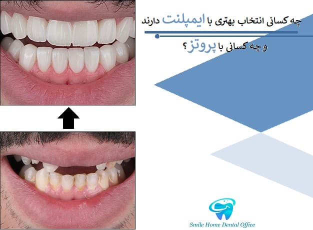 چه کسانی انتخاب بهتری با ایمپلنت دارند و چه کسانی با پروتز؟