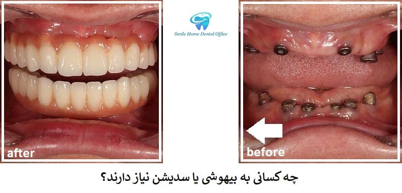 چه کسانی به بیهوشی یا سدیشن نیاز دارند؟