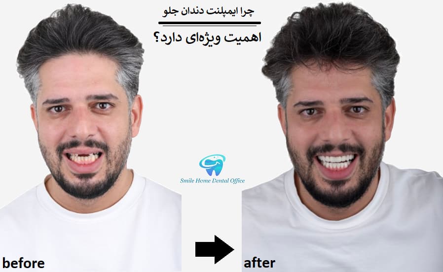 چرا ایمپلنت دندان جلو اهمیت ویژه‌ای دارد؟
