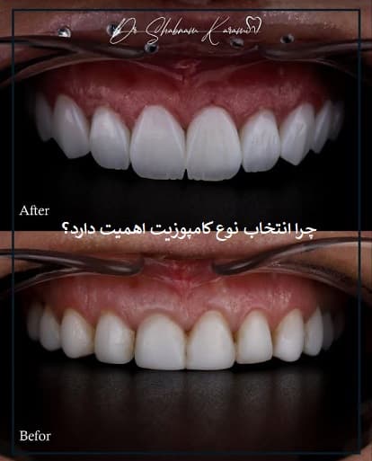 چرا انتخاب نوع کامپوزیت اهمیت دارد؟