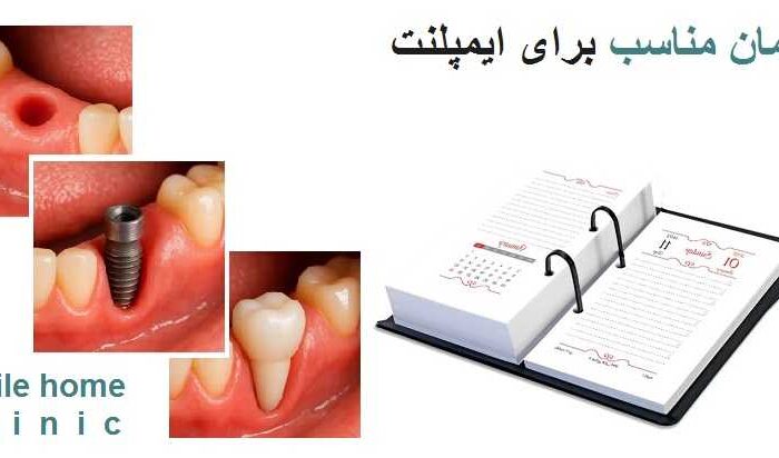 زمان مناسب برای ایمپلنت