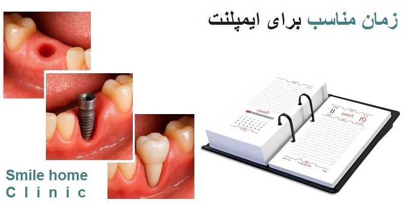 زمان مناسب برای ایمپلنت