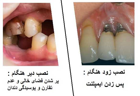 نصب زود یا دیر ایمپلنت چه عوارضی دارد ؟