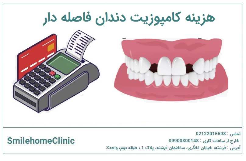 هزینه کامپوزیت دندان فاصلهدار