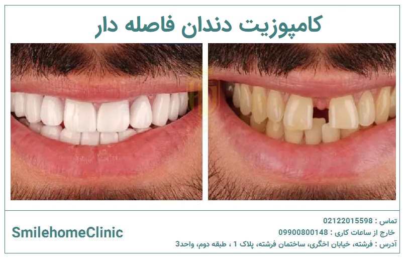 کامپوزیت دندان فاصله دار (2)