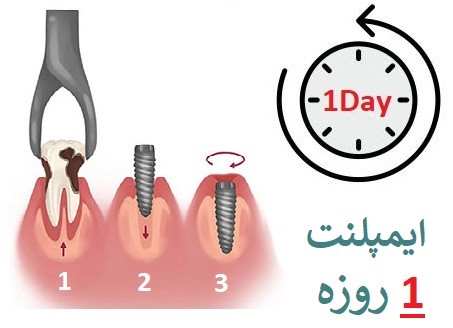 ایمپلنت فوری