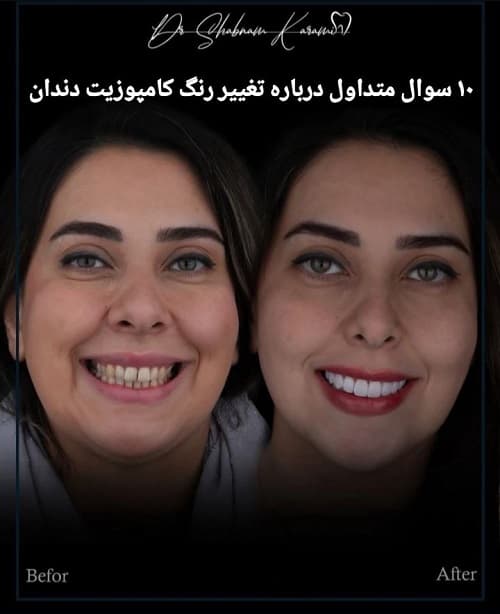 ۱۰ سوال متداول درباره تغییر رنگ کامپوزیت دندان