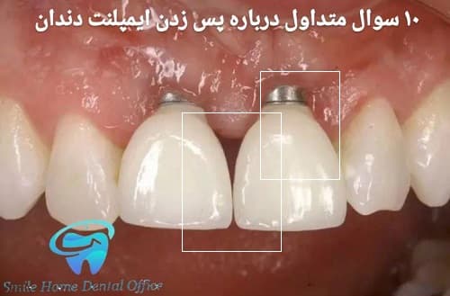 ۱۰ سوال متداول درباره پس‌زدن ایمپلنت دندان