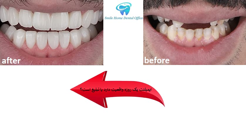 ایمپلنت یک روزه واقعیت دارد یا تبلیغ است؟