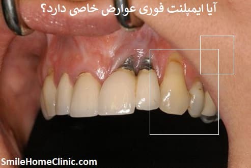 آیا ایمپلنت فوری عوارض خاصی دارد؟