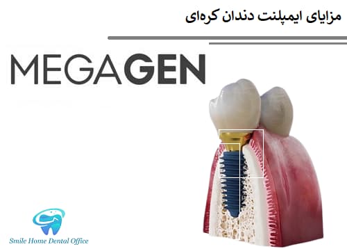 مزایای ایمپلنت دندان کره‌ای