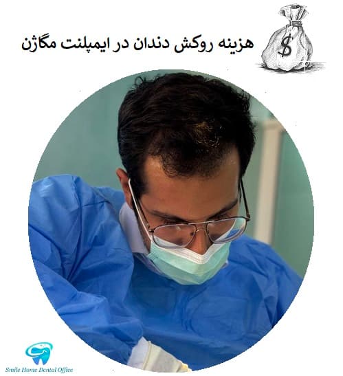 هزینه روکش دندان در ایمپلنت مگاژن