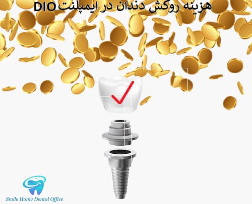 هزینه روکش دندان در ایمپلنت DIO