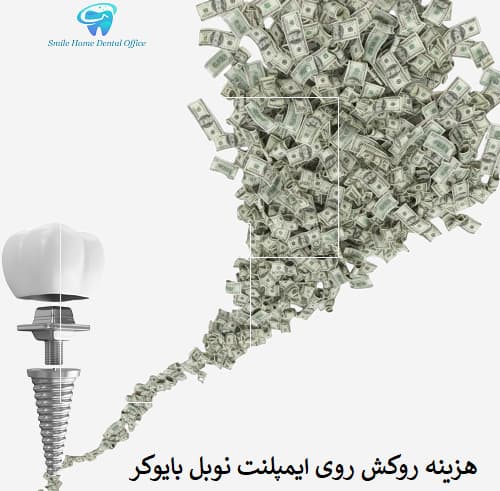 هزینه روکش روی ایمپلنت نوبل بایوکر