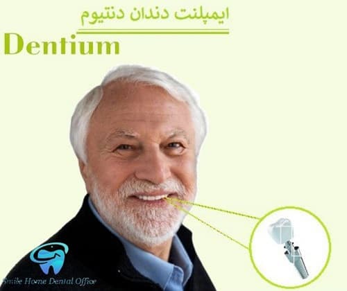 ایمپلنت دندان دندانیوم
