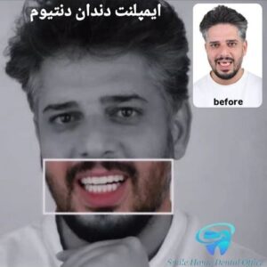 ایمپلنت دندان دندانیوم
