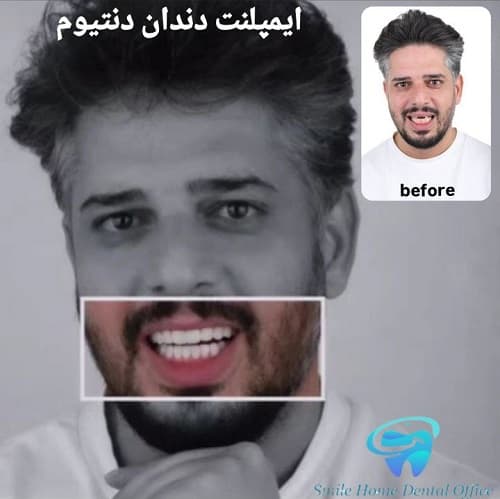 ایمپلنت دندان دندانیوم