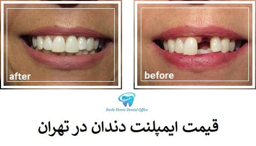 قیمت ایمپلنت دندان در تهران