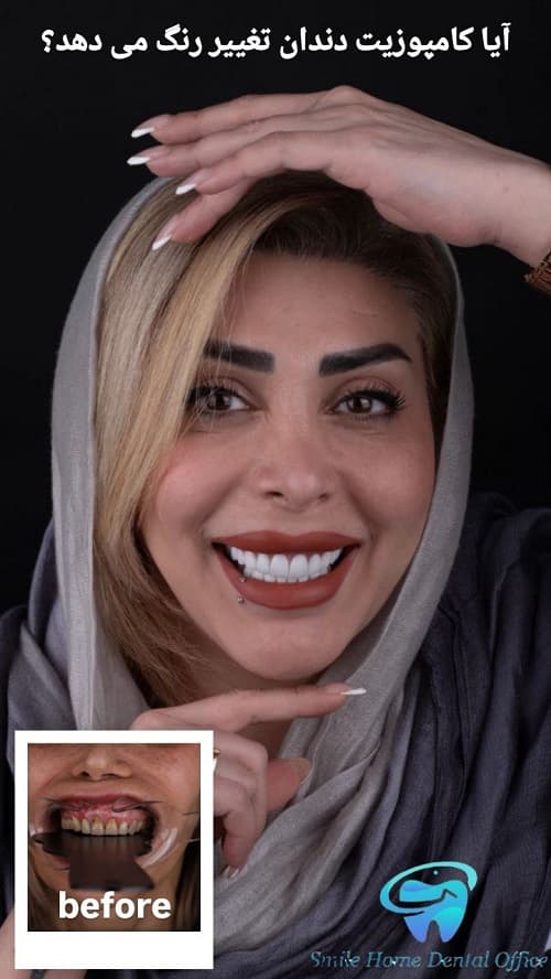 آیا کامپوزیت دندان تغییر رنگ می‌دهد؟