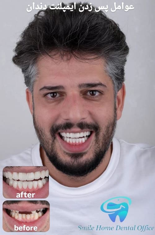 عوامل پس‌زدن ایمپلنت دندان