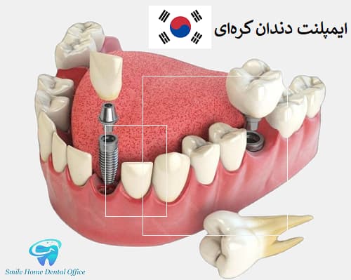 ایمپلنت دندان کره ای