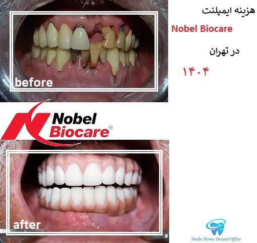 خدمات ایمپلنت Nobel Biocare در تهران ۱۴۰۴