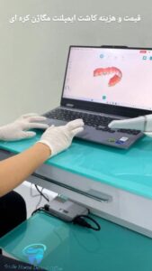 قیمت و هزینه کاشت ایمپلنت مگاژن کره