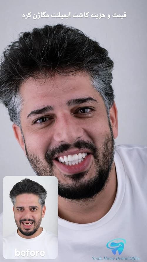 قیمت و هزینه کاشت ایمپلنت مگاژن کره