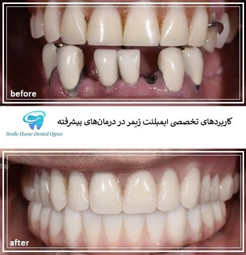 کاربردهای تخصصی ایمپلنت زیمر در درمان‌های پیشرفته
