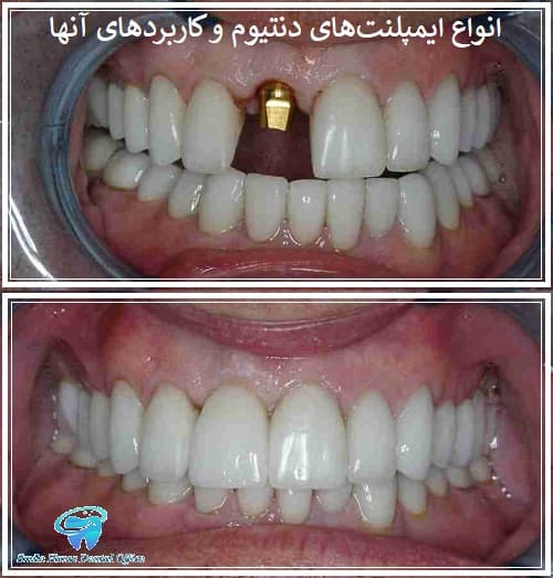 انواع ایمپلنت‌های دنتیوم و کاربردهای آنها