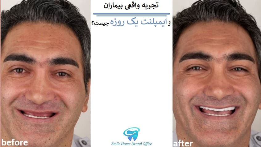 تجربه واقعی بیماران از ایمپلنت یک روزه چیست؟